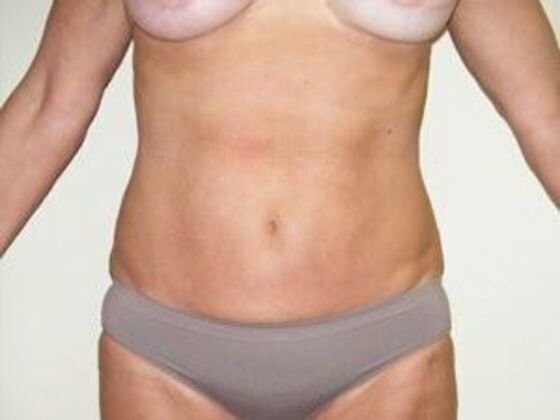 Liposuction Case 1 - After