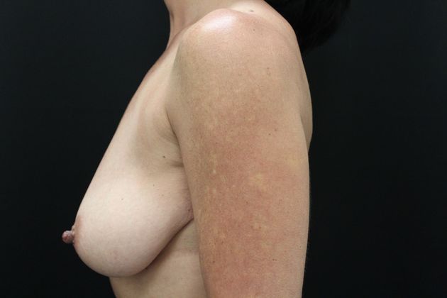 Breast Lift/Breast Lift Augmentation: Case 18 - Before