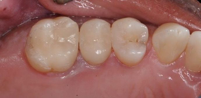 Cerec Case 1 - After