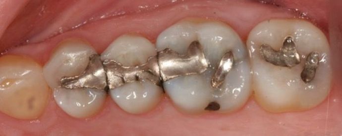 Cerec Case 2 - Before