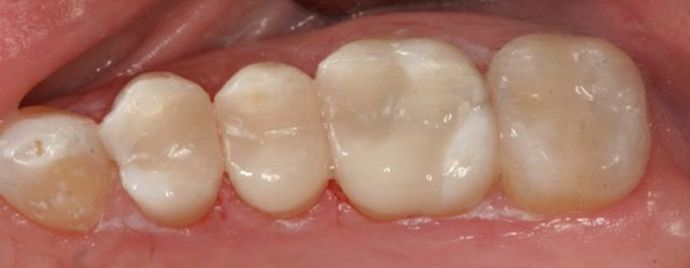 Cerec Case 2 - After