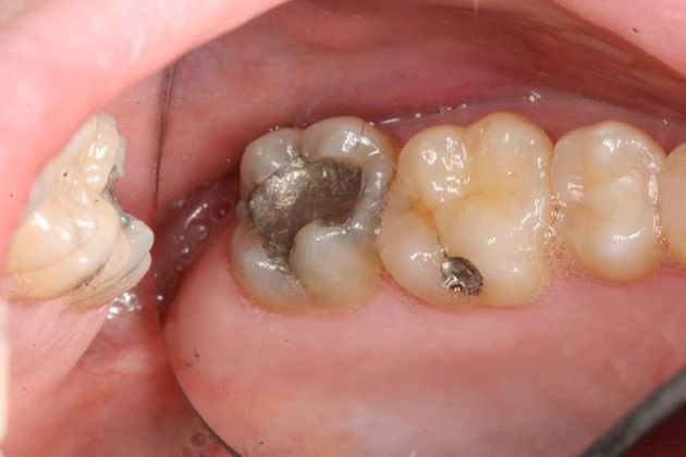 Cerec Case 3 - Before