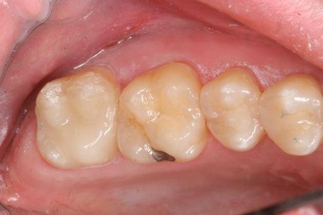 Cerec Case 3 - After