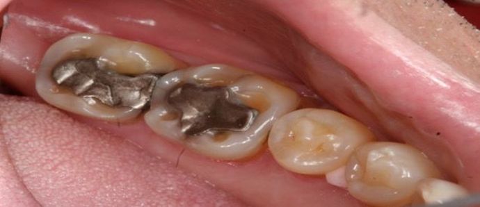 Cerec Case 4 - Before