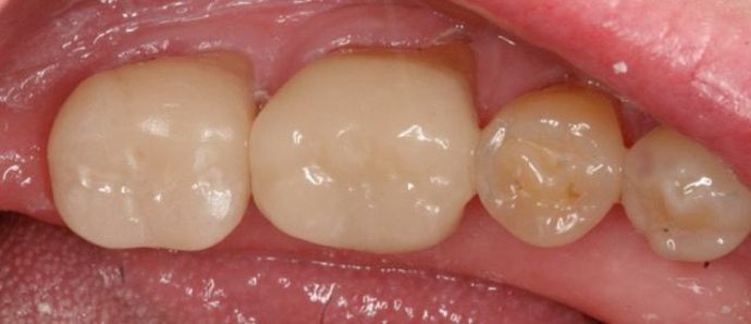 Cerec: Case 4 - After