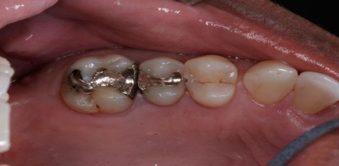 Cerec Case 1 - Before