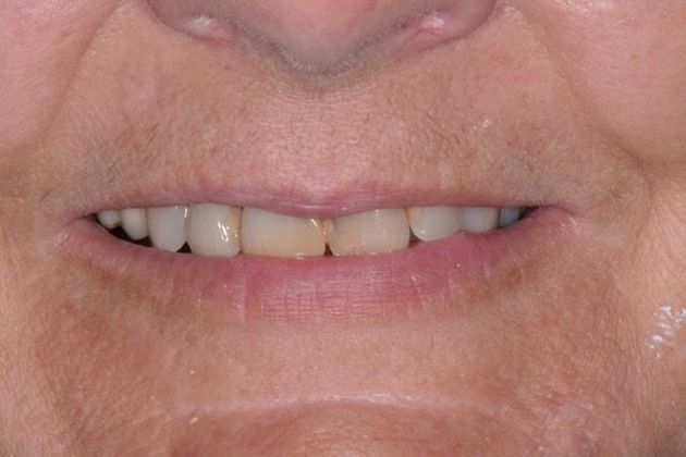 Veneers and Crowns: Case 2: Fort Mitchell, AL - Before