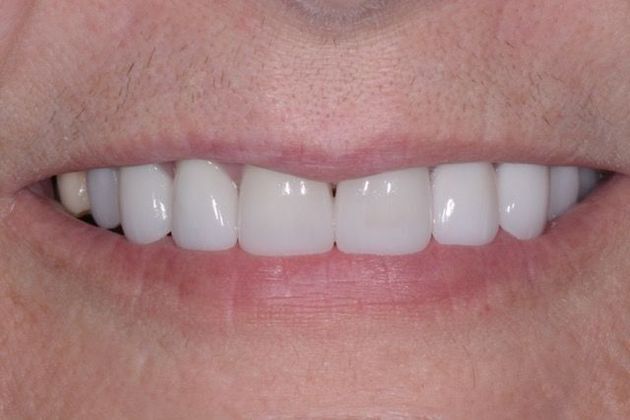 Veneers and Crowns: Case 2: Fort Mitchell, AL - After