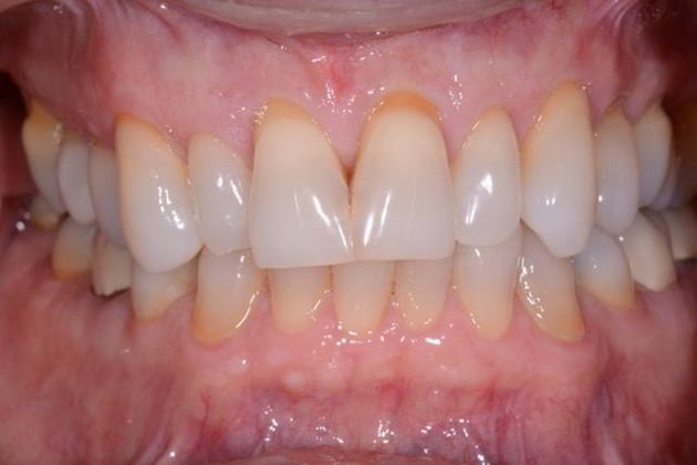 Veneers and Crowns: Case 4 - Before