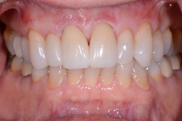 Veneers and Crowns: Case 4 - After