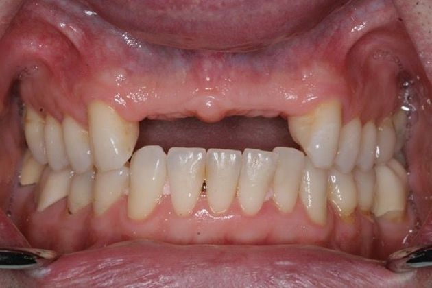 Veneers and Crowns Case 5 - Before
