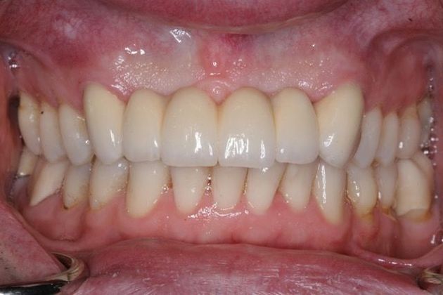 Veneers and Crowns Case 5 - After