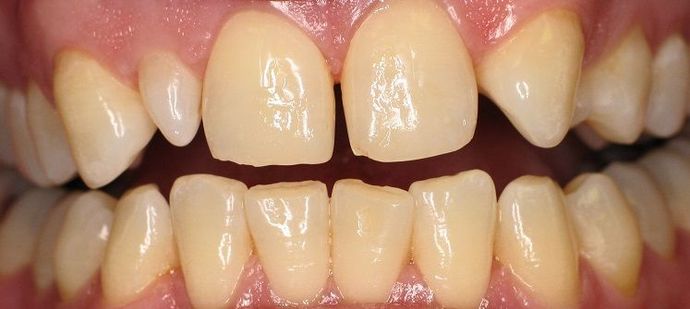 Porcelain Veneers Uneven Teeth replaced with Porcelain Veneers - Before