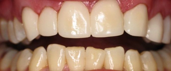 Porcelain Veneers Uneven Teeth replaced with Porcelain Veneers - After