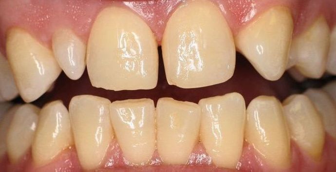 Porcelain Crowns Porcelain Crowns to correct size and spacing of teeth - Before