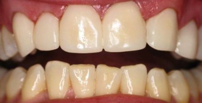 Porcelain Crowns Porcelain Crowns to correct size and spacing of teeth - After