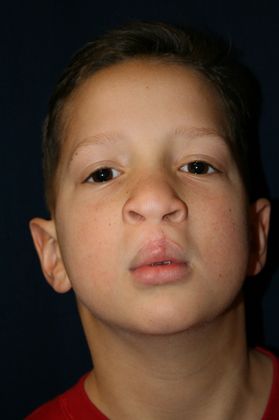 Cleft Lip*: Case 8 - 7 years of age. 