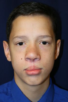 Cleft Lip*: Case 8 - After Secondary Nose Reconstruction. Age 14