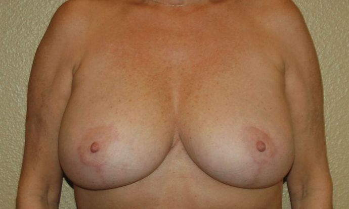 Breast Lift (Mastopexy) Case 35 - After