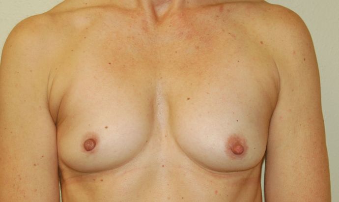 Breast Augmentation Case 349 - Before