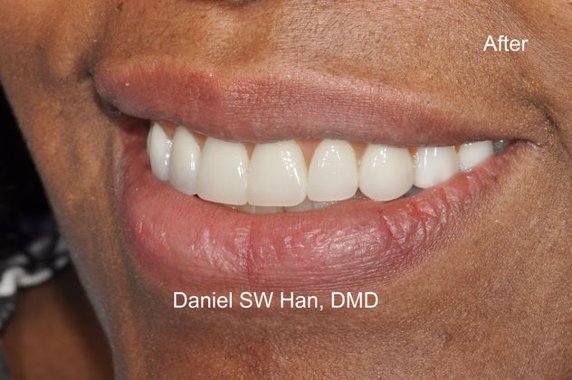 Full Mouth Reconstruction: Case 4 - Smile after treatment (Side profile) at 3 years postop