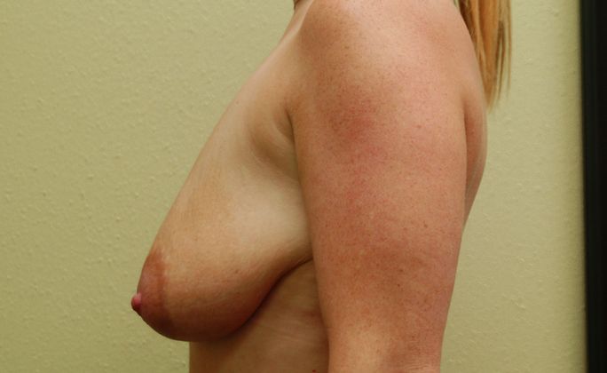 Breast Augmentation w/ Lift: Case 157 - Before