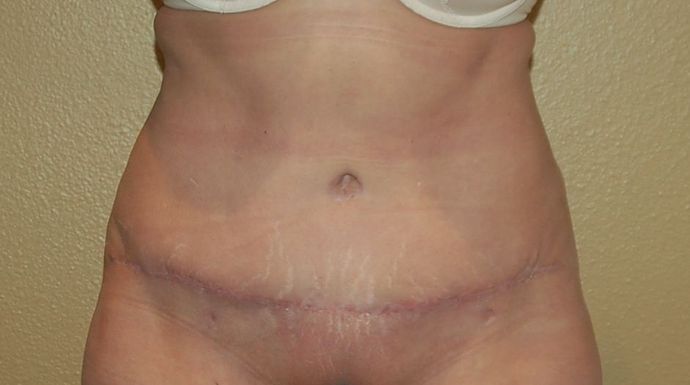Tummy Tuck (Abdominoplasty): Case 76 - After