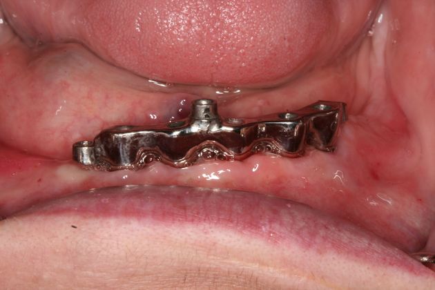 Dental Implants: Case 4 - Final Bar that dentures clip into (step 3)