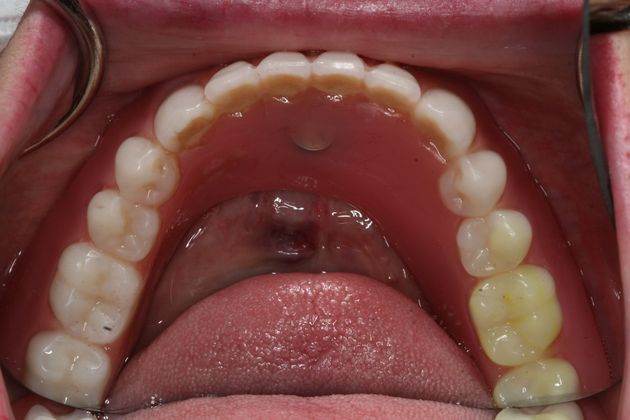Dental Implants: Case 4 - Final Lower Denture that clips into the bar 