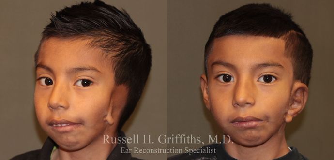 Case 1 One Stage Microtia Reconstruction For Hemifacial Microsomia