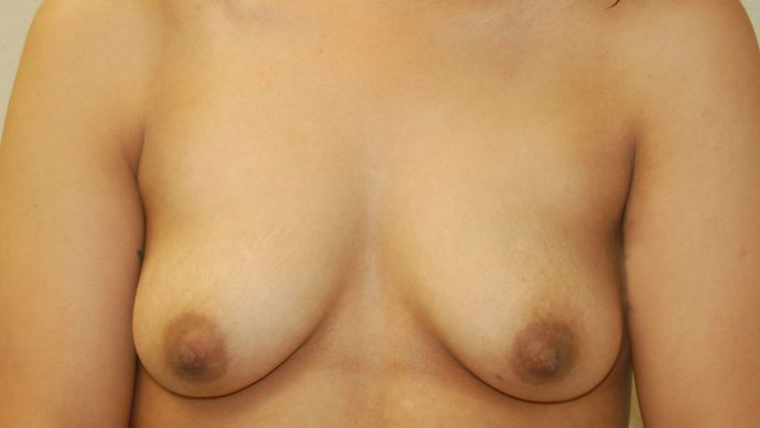 Breast Augmentation Case 356 - Before