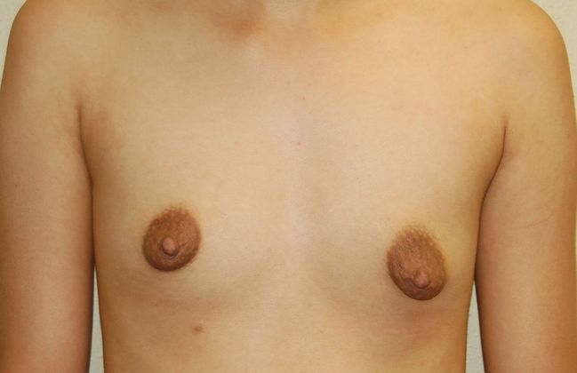 Breast Augmentation w/ Lift: Case 160 - Before