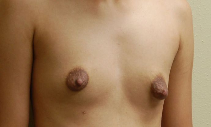 Breast Augmentation w/ Lift: Case 160 - Before