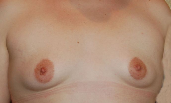 Breast Augmentation Case 358 - Before