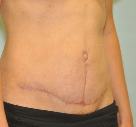 Tummy Tuck: Case 11 - Tummy Tuck, Darien - After