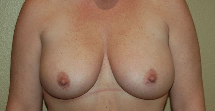 Breast Augmentation w/ Lift: Case 162 - Before