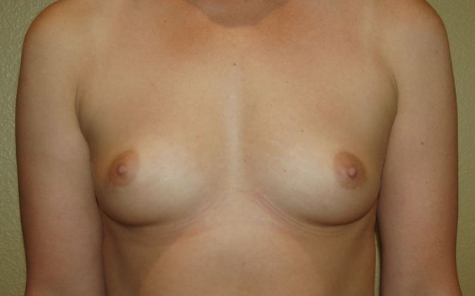 Breast Augmentation Case 360 - Before