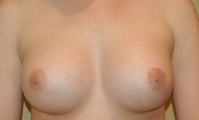 Breast Augmentation Case 360 - After