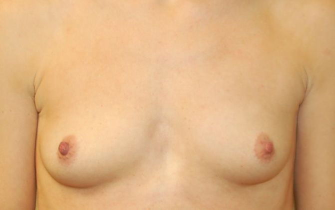 Breast Augmentation Case 361 - Before