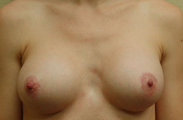 Breast Augmentation Case 361 - After