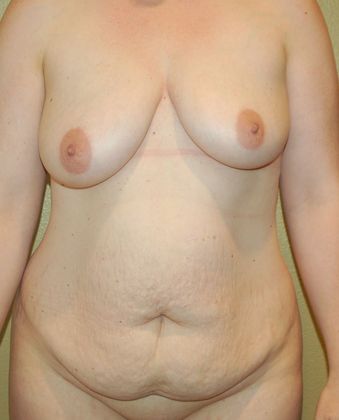 Mommy Makeover Case 68 - Before