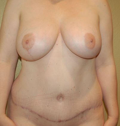 Mommy Makeover Case 68 - After