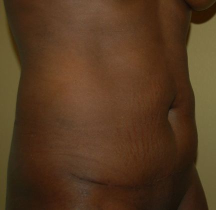 Tummy Tuck (Abdominoplasty): Case 79 - After