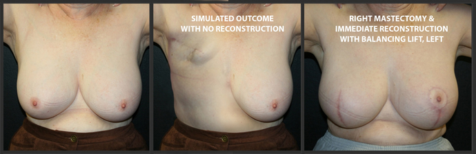 Breast Reconstruction: Case 1