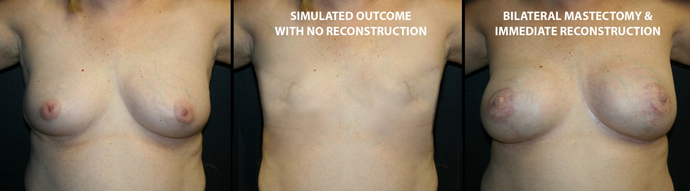 Breast Reconstruction: Case 2