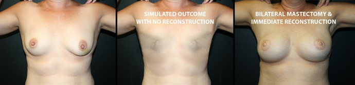 Breast Reconstruction Case 3