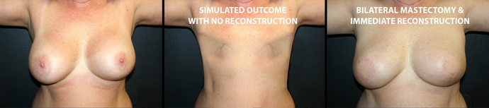 Breast Reconstruction: Case 4