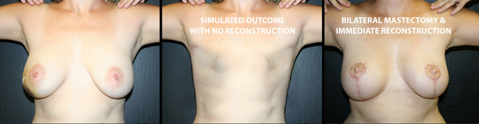 Breast Reconstruction Case 5