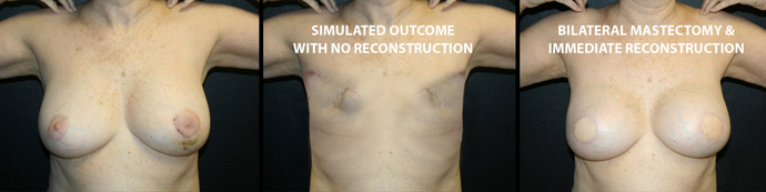 Breast Reconstruction: Case 6