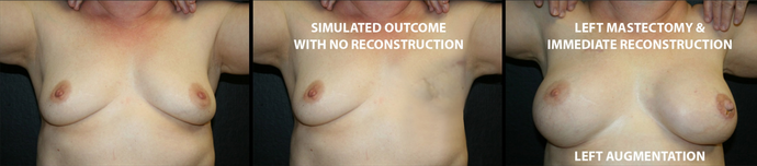 Breast Reconstruction: Case 7